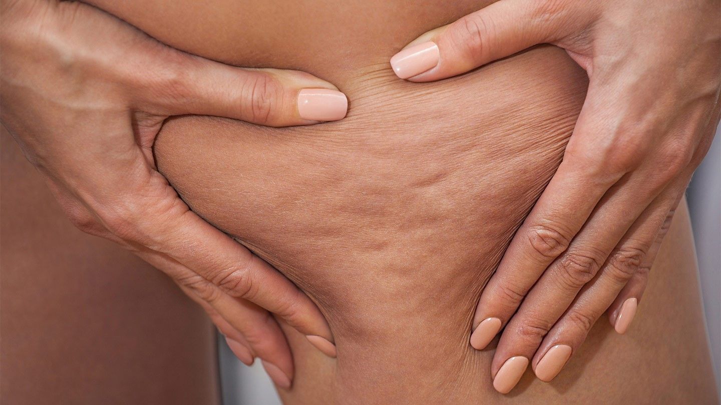 Global Cellulite Treatment Market 2021 - Top Key Players Analysis Report Till 2027