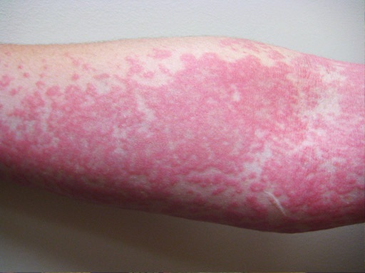 Can Kidney Problems Cause Urticaria?