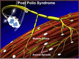 Post-polio Syndrome Treatment Market: Covid-19 Impact Analysis, Supply Demand Scenario and Growth Prospects Survey till 2030 investigated in the latest research