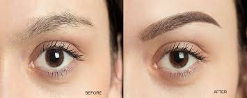 Eyebrow Hair Transplant in Pakistan Success Stories and Insights