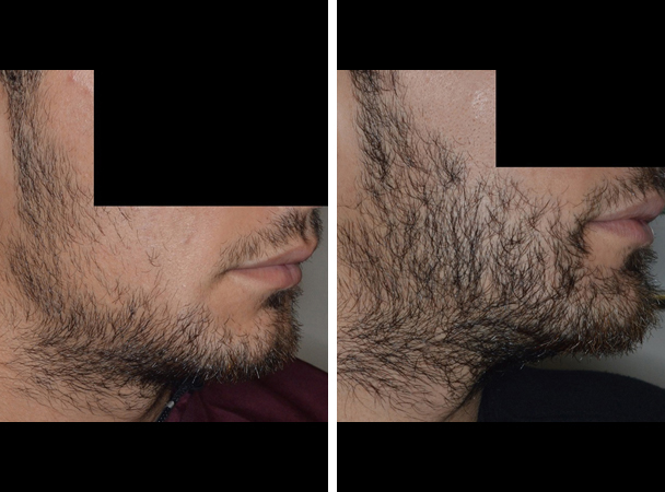 Facial Hair Restoration the Ultimate Solution for Bold Masculine Look