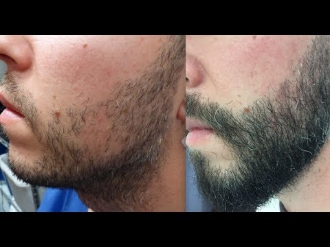 The Modern Solution for a Fuller Natural Beard