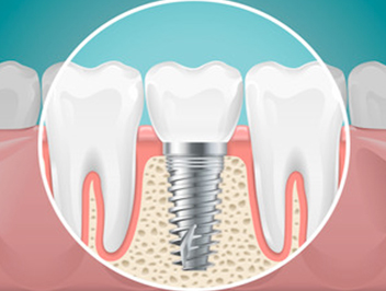 Best Implant Dentist in Dubai