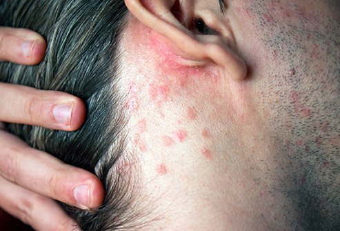 The health care provider will be able to determine which Psoriasis Treatments are appropriate.