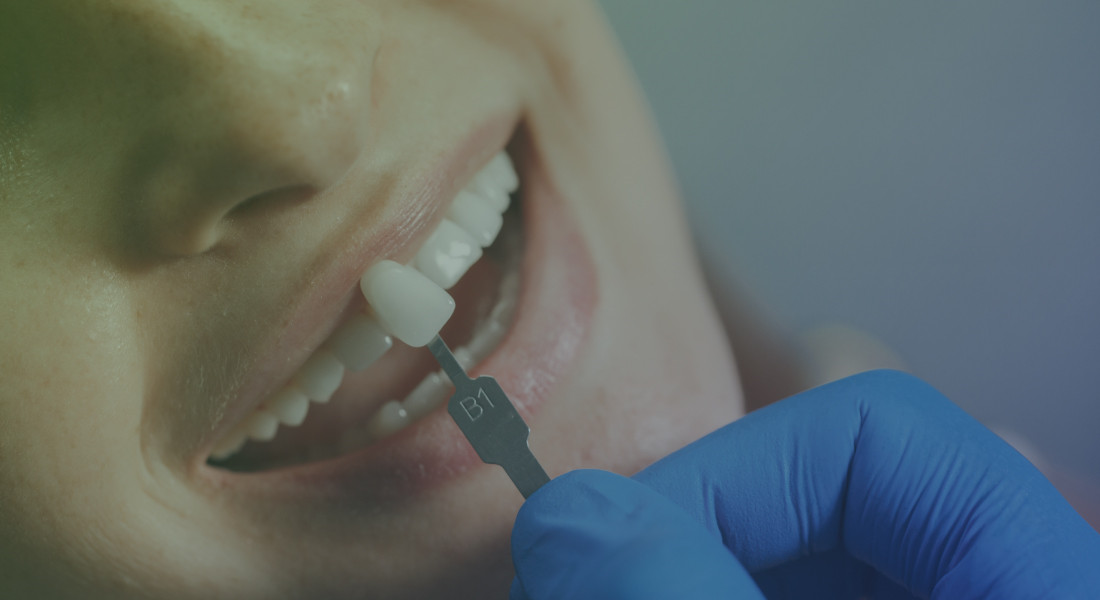Exploring the Benefits of Dental Veneers: A Comprehensive Guide
