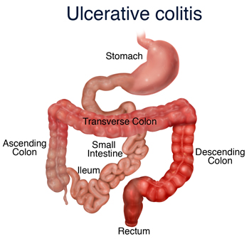 Ayurvedic Medicine For Ulcerative