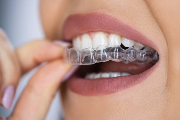 Transform Your Smile with Center Invisalign: A Comprehensive Guide