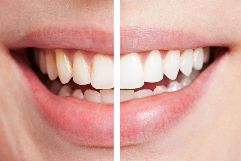 Different Types Of Porcelain Veneers