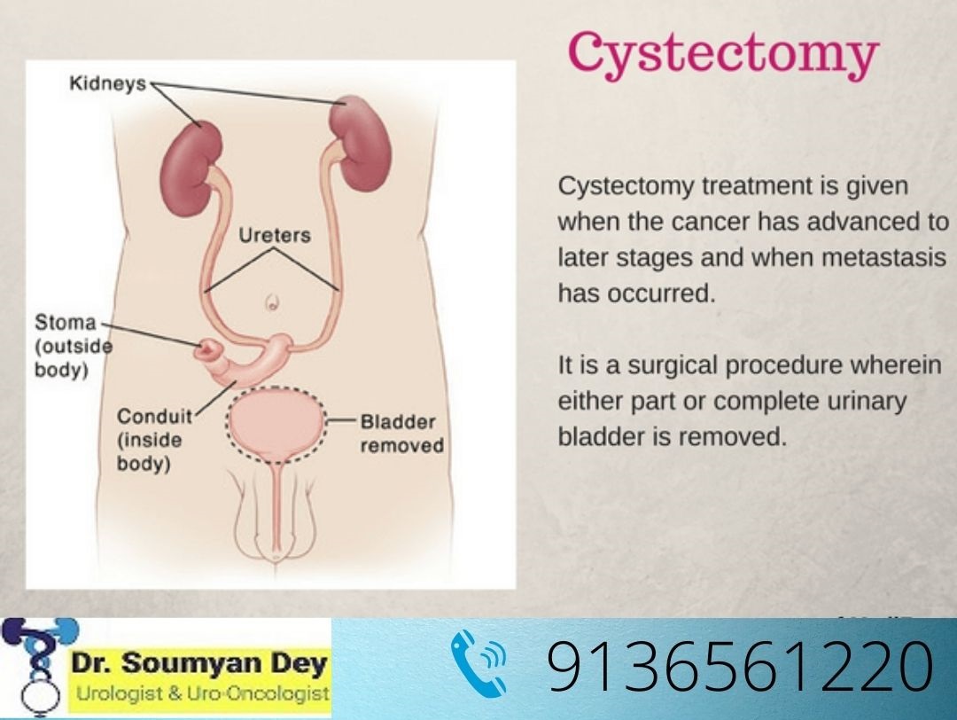 What is Cystectomy Or Bladder removal ? Life After Cystectomy | Bladder Cancer Treatment Mumbai & Thane India