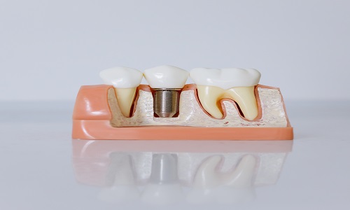 Filling the gap: What are your tooth replacement options?