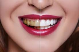 All You Need To Know About Deep Teeth Cleaning and Dental Filling
