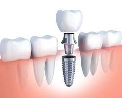 3 Signs You Need Dental Implants Emergency Dentist