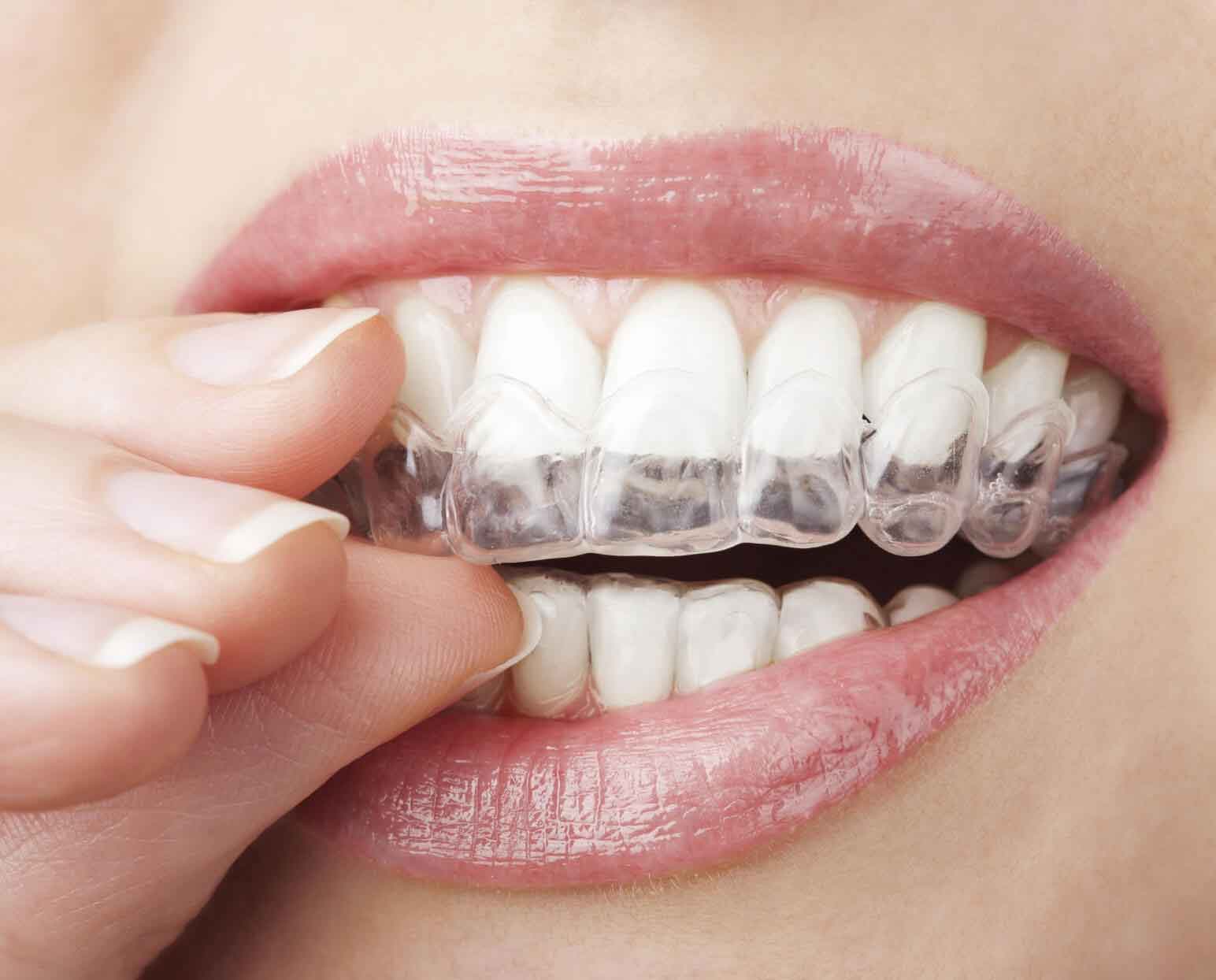 Essential Tips to Find the Best Invisalign Provider