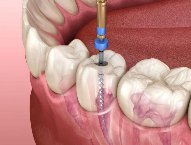 What Happens if You Ignore a Tooth Infection?