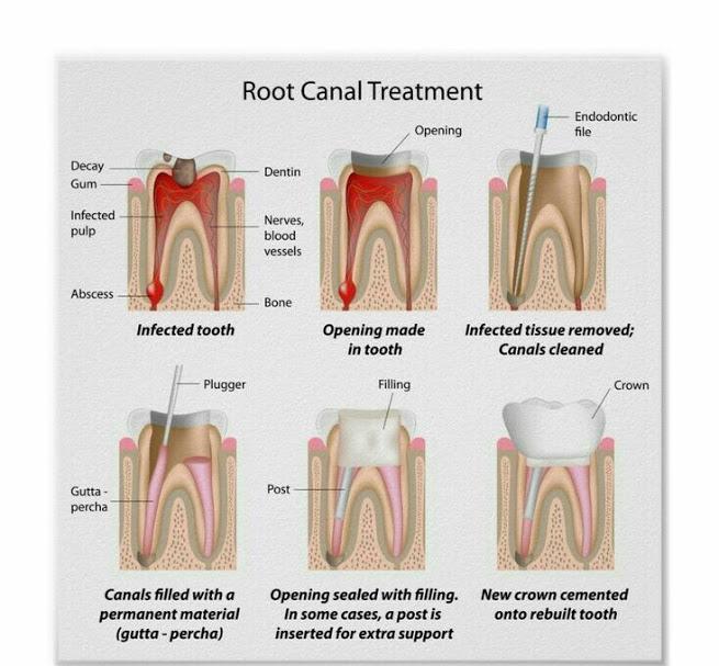 How to make your dental cleaning last For Longer