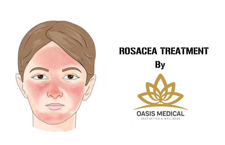 Lessen The Effects Of Rosacea Via Skin Resurfacing