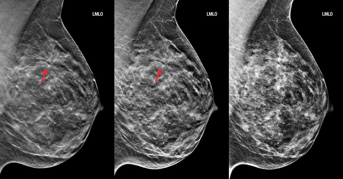 Breast Imaging: Exploring the Technologies Improving Early Detection