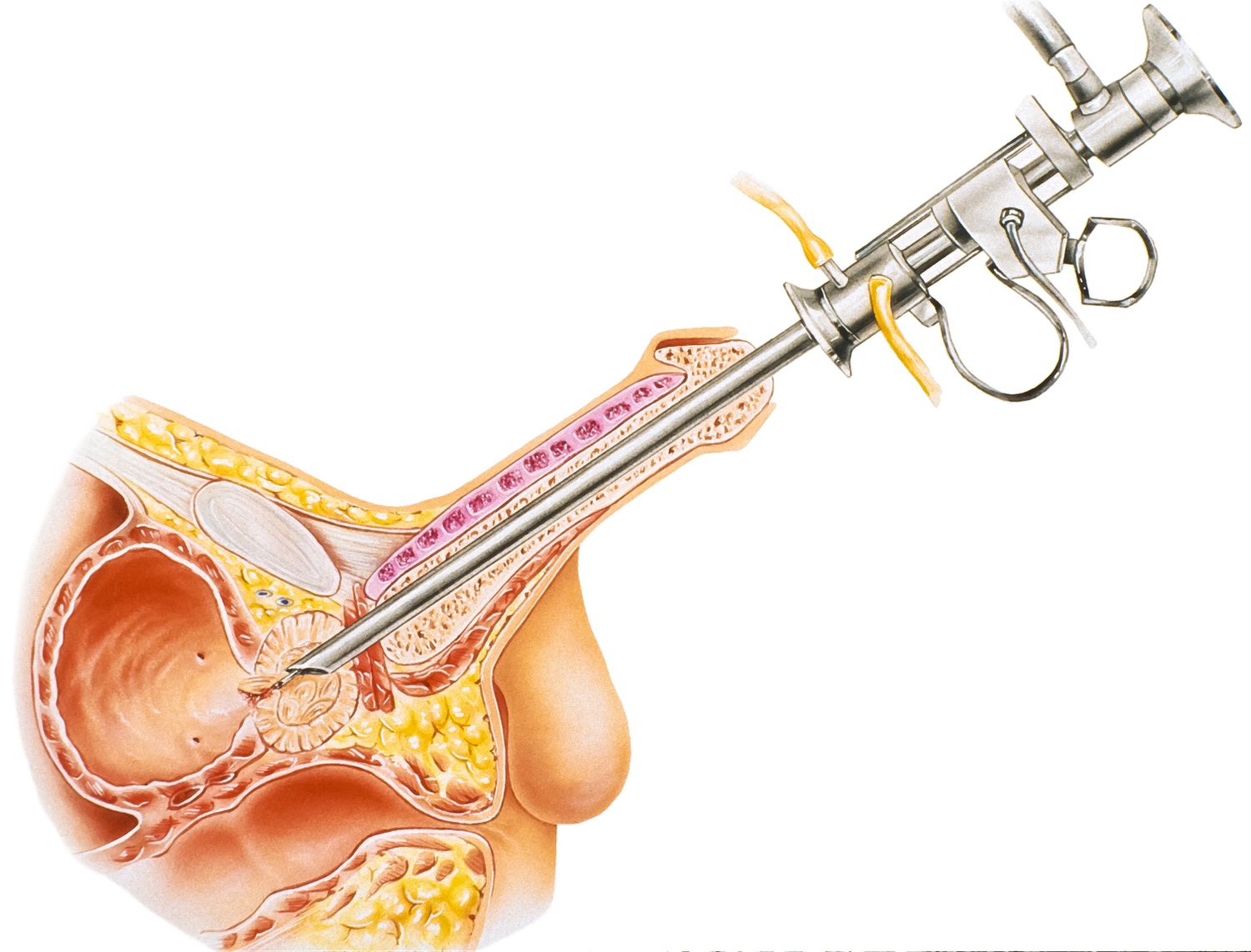 Bladder Liners: An Effective Solution For Incontinence Management 