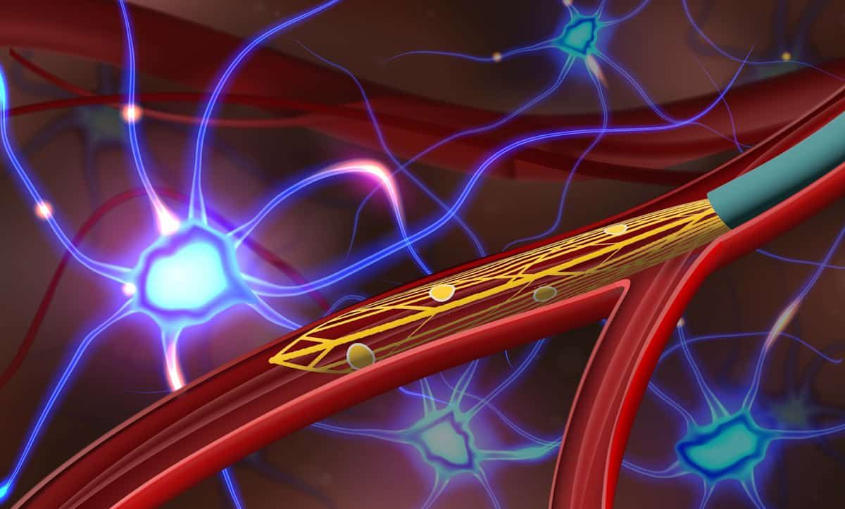 Enhancing Precision And Efficacy With Global Microcatheter: Applications And Impact