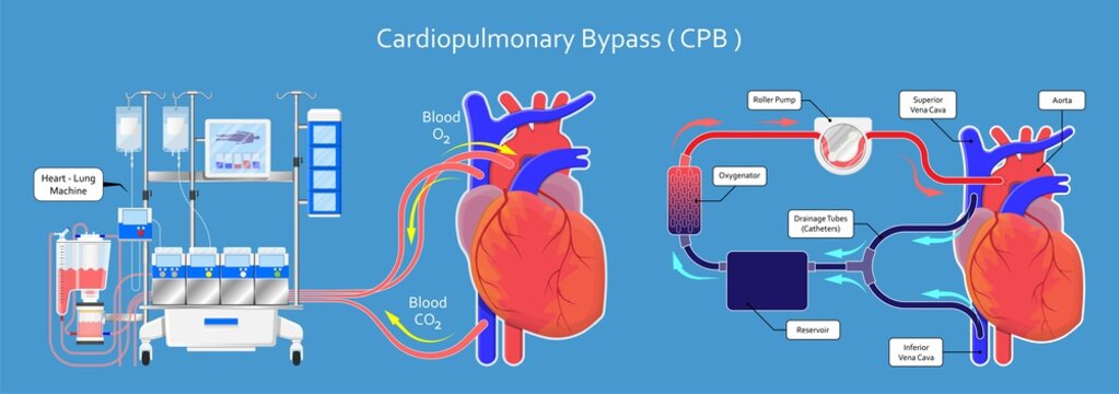 Cardiopulmonary Bypass Equipment Market Will Grow At Highest Pace Owing To Rising Geriatric Population 