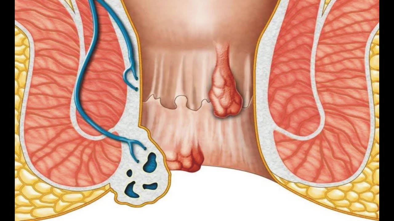 Relief On The Horizon: Navigating The Anal Fissure Treatment Market