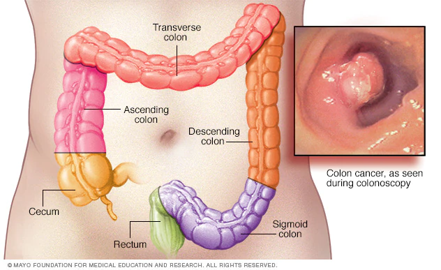 What are causes of colon cancer and some risk factor