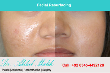 Facial Resurfacing Surgery In Lahore