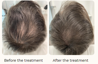 Get Finasteride Online