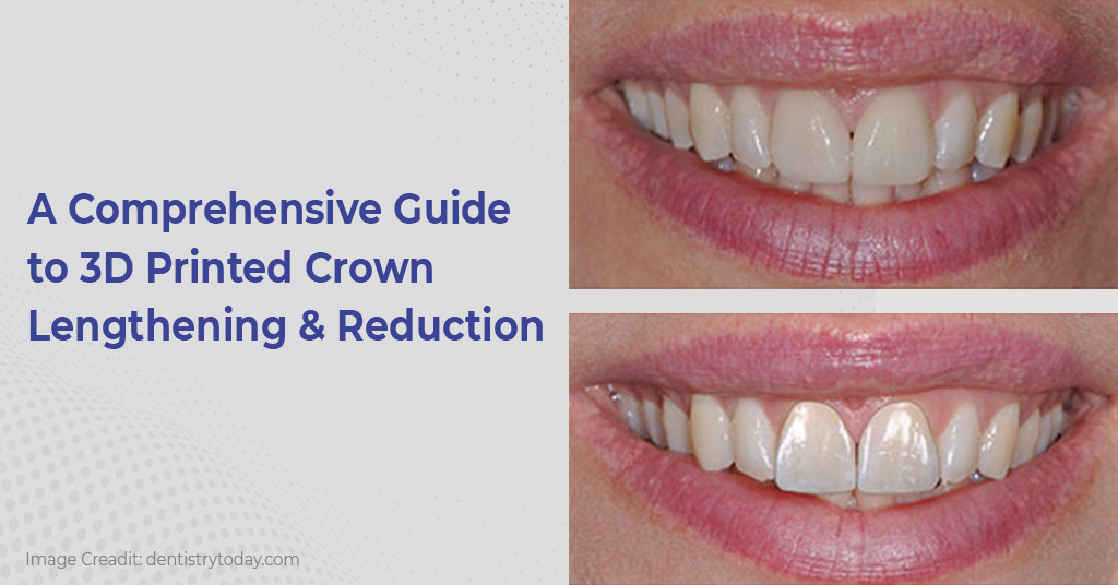 A Comprehensive Guide to 3D Printed Crown Lengthening & Reduction - ICPA Health Products Ltd