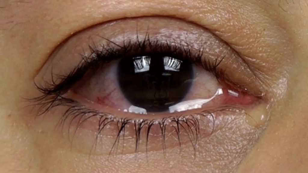What are causes of watering eyes?