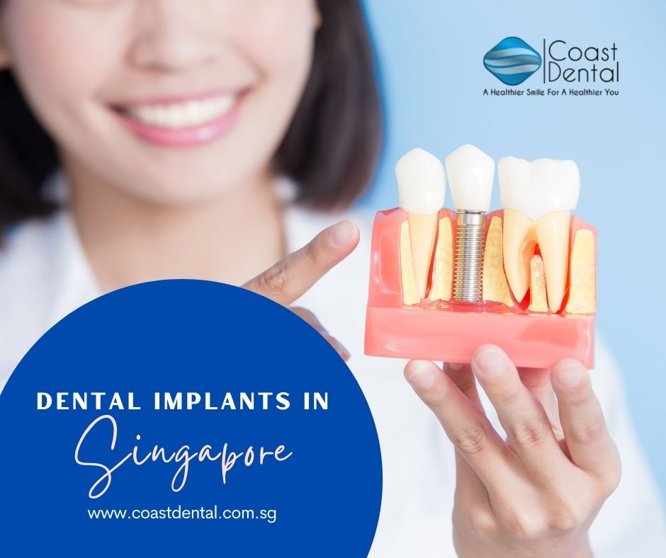 Dental Implant Singapore