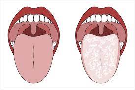 Candidiasis Market- Size, Share, Outlook, and Opportunity Analysis, 2018-2026