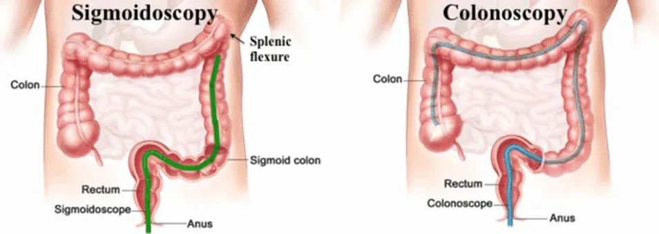 An Ultimate Guide To Colonoscopy Screening Process