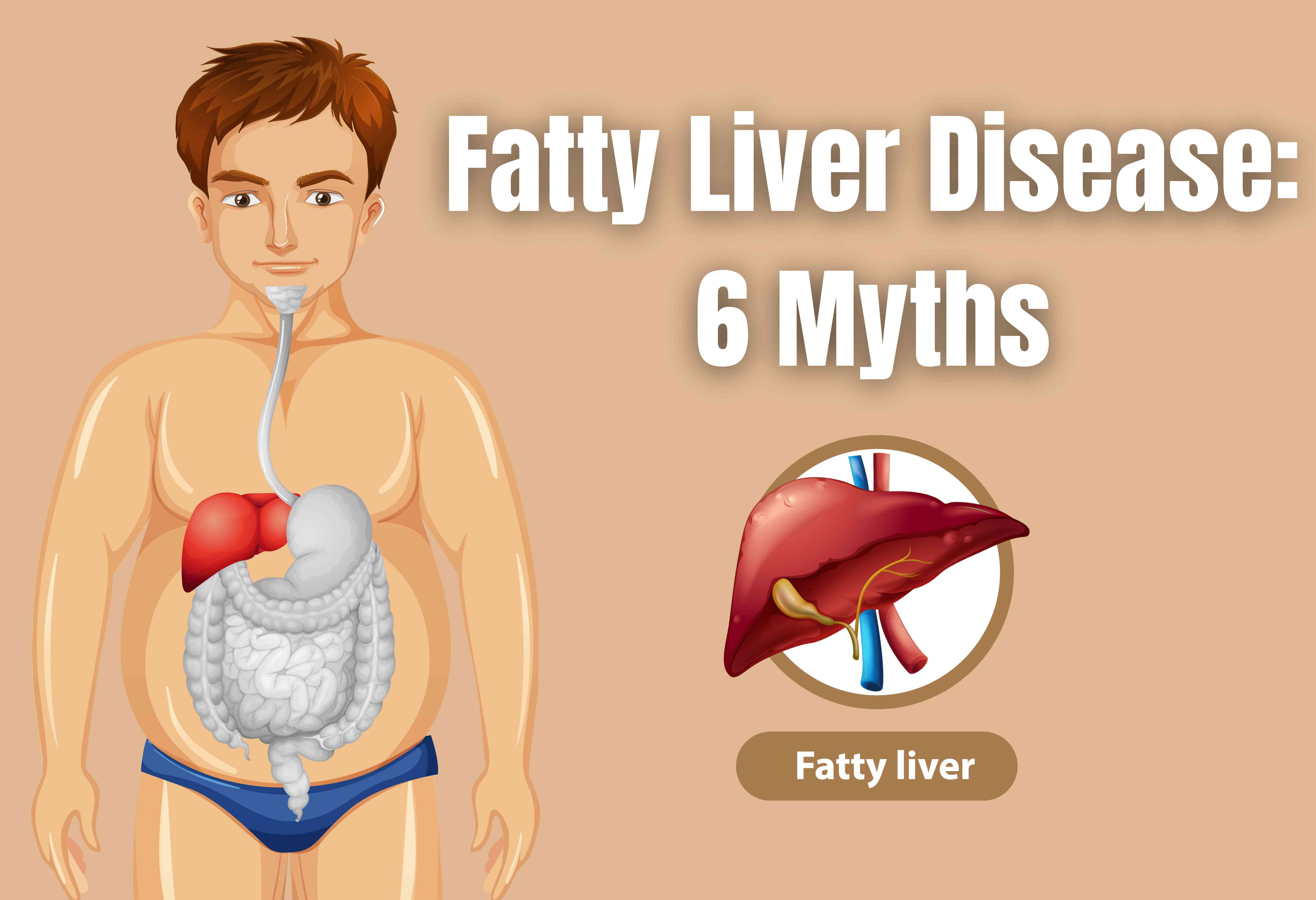 Fatty Liver Disease: 6 Myths