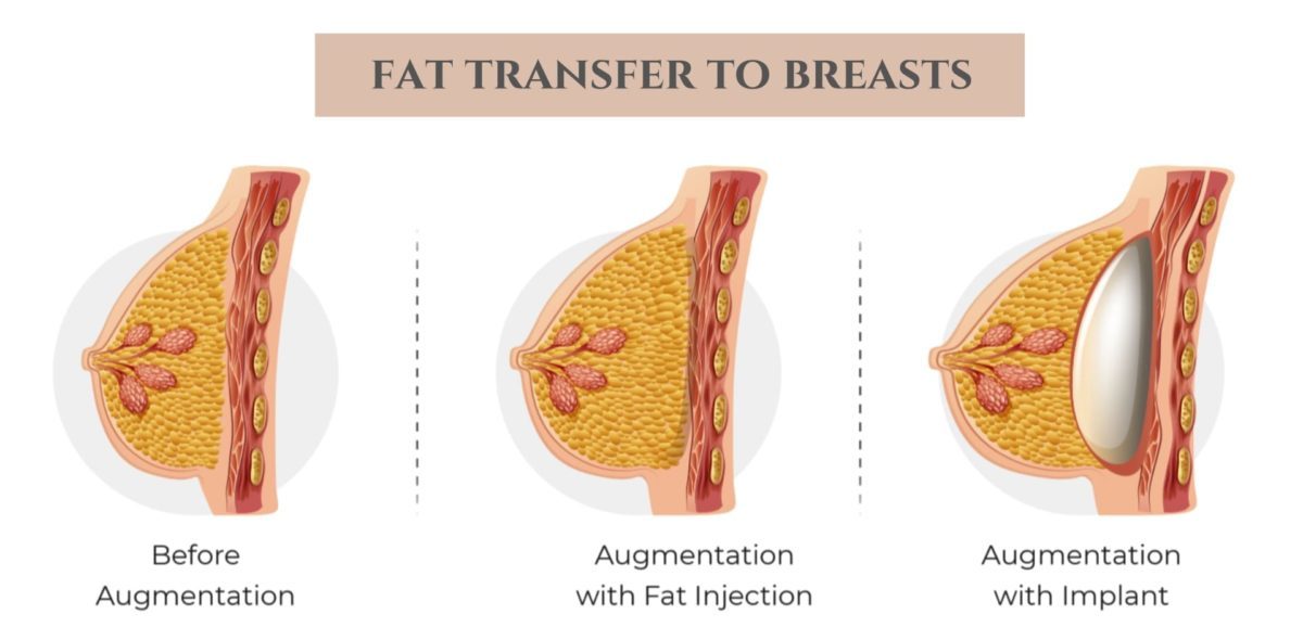 Fat Transfer Isn’t Harmful