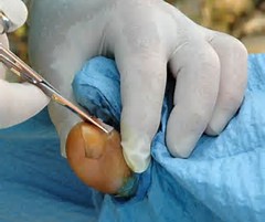 Best Ingrown Toenail Surgery