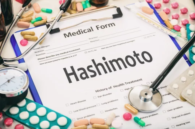 The Hashimoto Treatment To Help You Out