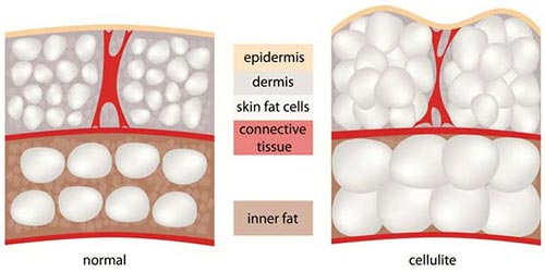 Best Cellulite Treatment Toronto
