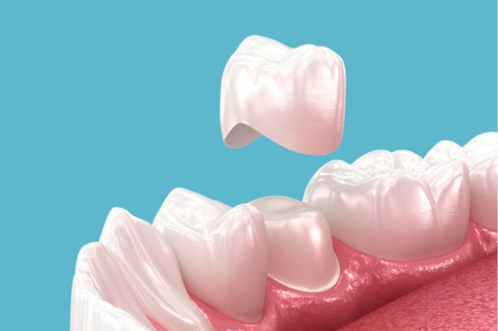 How Long Do Dental Crowns and Bridges Last?