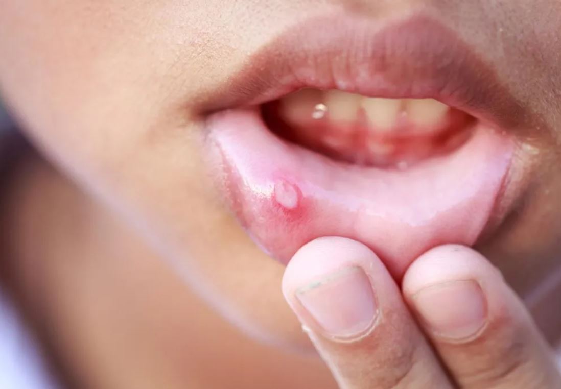 Mouth Ulcer Treatment Market In-Depth Analysis On Forthcoming Development And Forecast By 2027