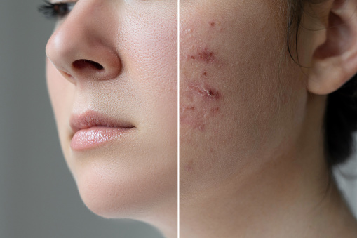 Acne Got You Down? Try These Great Ideas!
