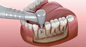 Tips For Lowering The price of Your Dental Implants