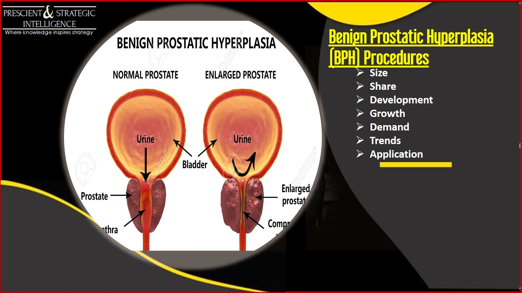 US Benign Prostatic Hyperplasia Procedures Market Industry Global Manufacturers Analysis and Industry Overview to 2023