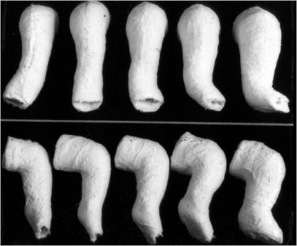Clubfoot Treatment for Babies