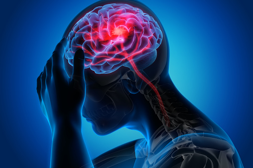 Stroke treatment in Dubai
