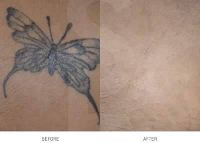 Tatto Removal Auckland