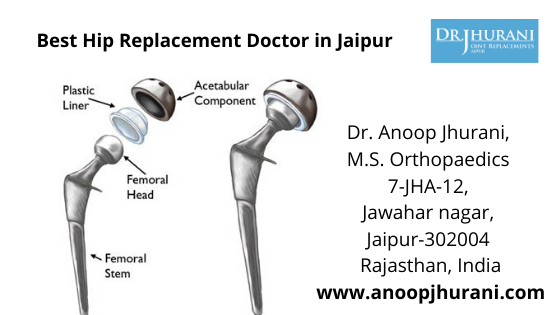 Best Hip Replacement Doctor in Jaipur Best Hip Replacement Surgery
