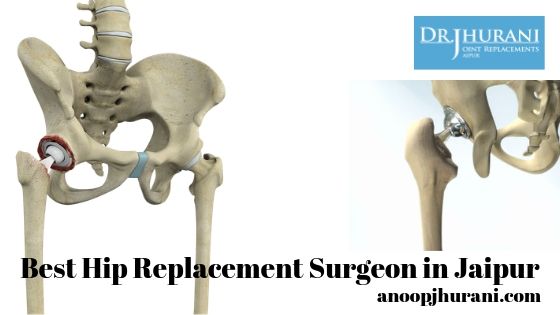 Best Hip Replacement Surgeon in Jaipur Orthopaedic Surgeon Knee Joint Surgery