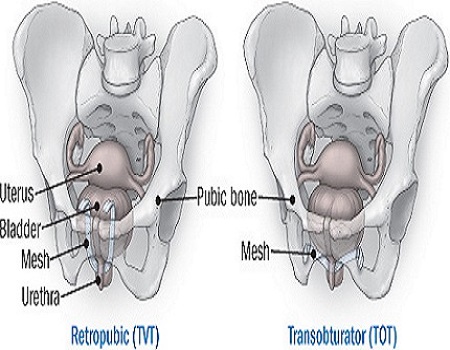 Best Prostate Surgery in Pune | Dr. Amol Talaulikar