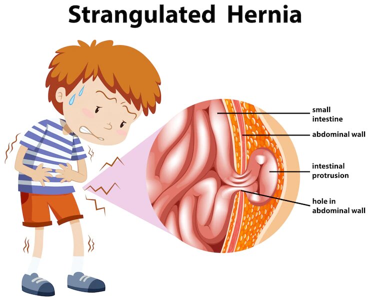 Here is what All about Adult Umbilical Hernia Surgery